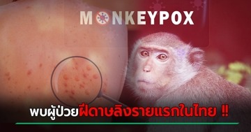 ฝีดาษลิง โผล่ไทยแล้ว ! สธ. ยืนยันพบผู้ป่วยที่ จ.ภูเก็ต ขอประชาชนอย่าตื่นตระหนก 