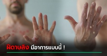 หมอรามาฯ เผยอาการ ฝีดาษลิง จาก 16 ประเทศ คล้ายซิฟิลิสจนหมอสับสนบางเคส