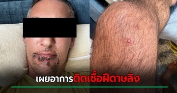 อย่าชะล่าใจ ! หนุ่มแชร์ประสบการณ์ติดเชื้อฝีดาษลิง อาการเข้าขั้นโหด - เผยสภาพแผล  